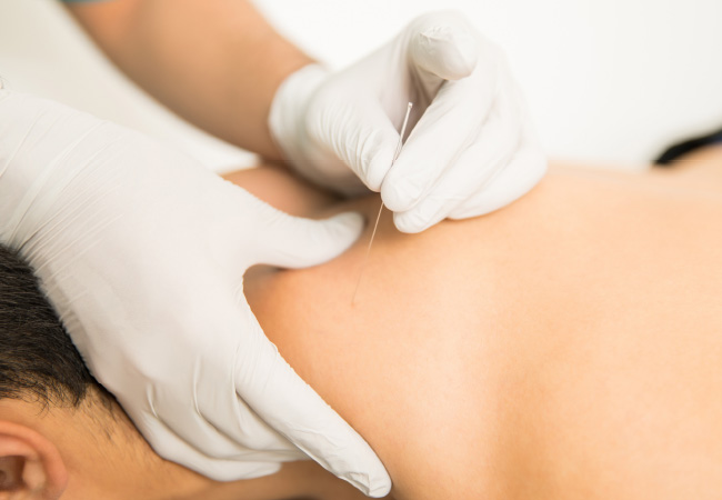 EXPLORING DRY NEEDLING: WHAT IT IS AND HOW IT HELPS