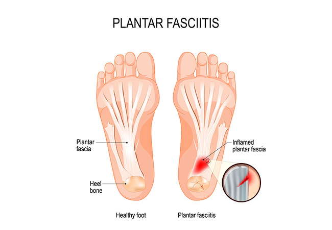 Plantar Fasciitis: The Most Common Cause of Heel Pain Revealed!